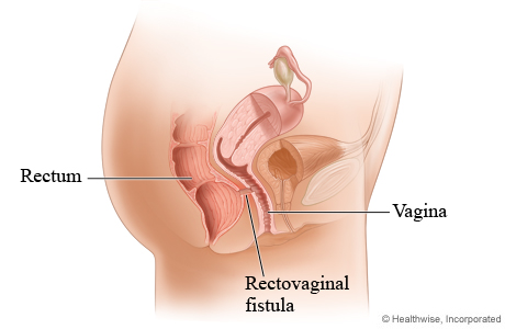 Picture of a rectovaginal fistula