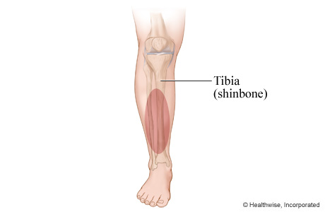 Location of shin splints