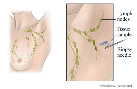 Core needle lymph node biopsy