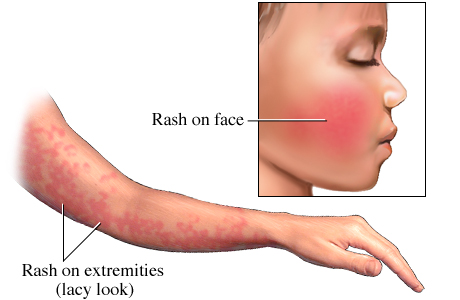 Picture of fifth disease (erythema infectiosum) rash on face and arm