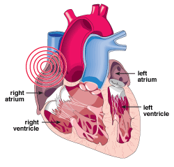 The sinus node is found in the right atrium, where the electrical pulse that makes the heart beat begins. An irregularity in these pulses, such as when the heart beats faster or slower than normal, is known as an arrhythmia.