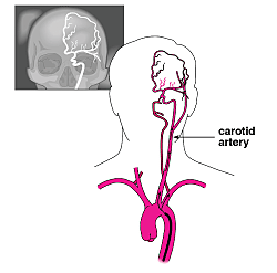 The mitral valve consists of two leaflets attached via tendinous cords (mitral chordae) and two major papillary muscles to the left ventricular wall (myocardium), supported by connective tissue (mitral annulus). 