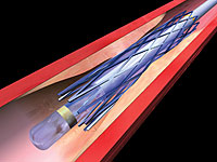 The balloon catheter carrying the stent is positioned in the narrowed section of the artery, and the balloon is inflated, expanding the stent.