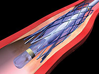 The vascular stent is fully extended via the inflation of the balloon catheter, widening the lumen of the artery.