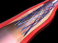 After the vascular stent is fully extended, the balloon catheter is removed, leaving the expanded stent to hold the artery lumen open.