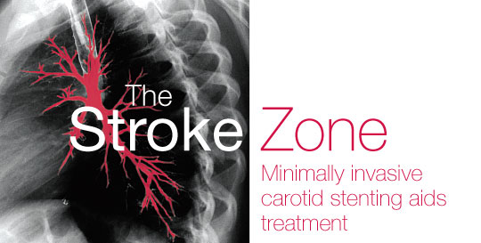 The Stroke Zone Graphic