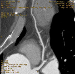 This cardiac CT angiogram (curved multi-planar reformat) demonstrates a 20% stenosis of the left main coronary artery followed by a 40% stenosis of the ostium of the left anterior descending artery with distal luminal irregularities. 