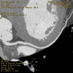 This cardiac CT angiogram is a curved multiplanar reformat, demonstrating luminal irregularities (mild atherosclerosis) of the right coronary artery. 