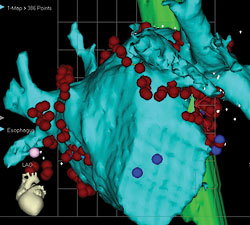 Anterior (above) and posterior (below) views of CT scan-guided reconstruction of the left atrium during atrial fibrillation ablation. The tree-like branch structures emanating from the left atrium represent the pulmonary veins. The red dots represent ablation lesions encircling the pulmonary veins. In one view, the bright green structure represents the esophagus, which sits right behind the left atrium.