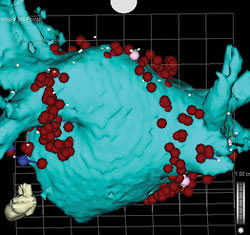 Anterior (above) and posterior (below) views of CT scan-guided reconstruction of the left atrium during atrial fibrillation ablation. The tree-like branch structures emanating from the left atrium represent the pulmonary veins. The red dots represent ablation lesions encircling the pulmonary veins. In one view, the bright green structure represents the esophagus, which sits right behind the left atrium.